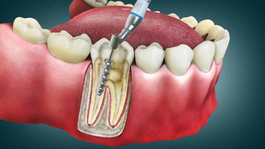 ROOT CANAL TREATMENT COST IN JAIPUR